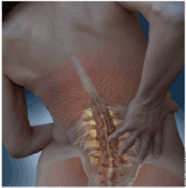 Spinal stenosis crimps the nerves in the lower back